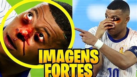 MBAPPÉ QUEBRA O NARIZ VEJA AS IMAGENS VAI FICAR FORA DA EURO YouTube