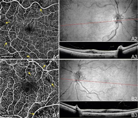 Octa Of Npdr The Right Eye A And Left Eye B Of A Year Old