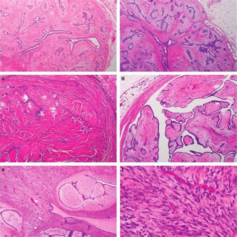 Histology of fibroadenoma and phyllodes tumor on surgical excisions. a,... | Download Scientific ...