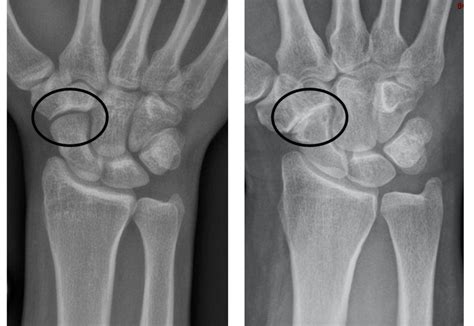 Tri-scaphoid/STT Joint Osteoarthritis – The Lothian Hand Unit