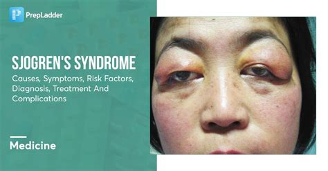 Sjogren's Syndrome Causes, Symptoms, Diagnosis, Prognosis, 60% OFF