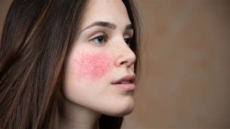 How To Get Rid Of Rosacea 10 Natural Remedies — Best Life