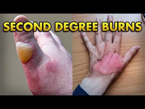 Second Degree Burn