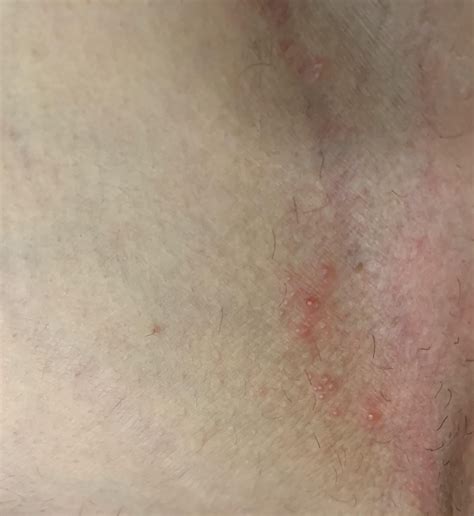 Non itchy or painful red bumps all around groin : r/DermatologyQuestions