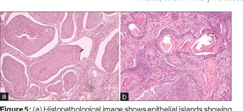 Pdf Primary Intraosseous Squamous Cell Carcinoma A Rare Odontogenic