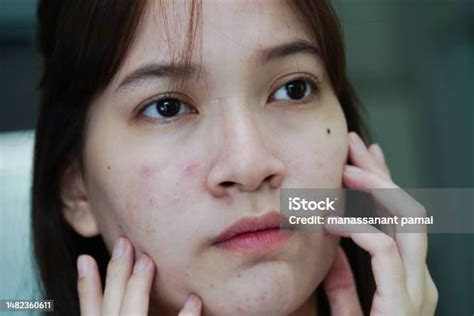 Acne Pimple And Scar On Skin Face Disorders Of Sebaceous Glands Teenage ...