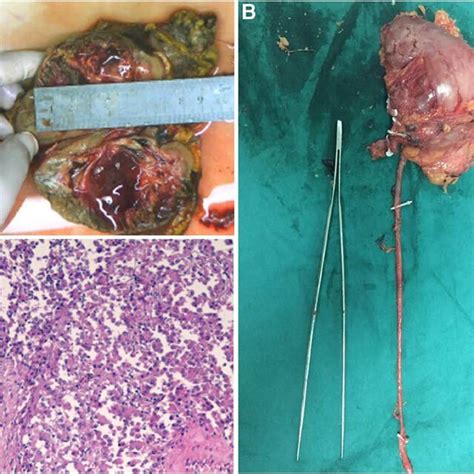 A The Tumor Specimen B The Resected Specimen C Pathological