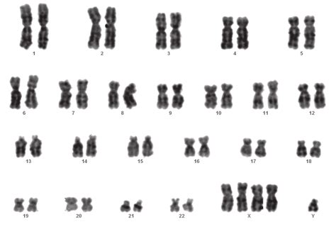 G Banded Metaphase Image Showing Chromosome X Tetrasomy In The Patient Download Scientific