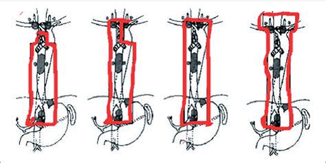 Linfadenectomía De 2 Y 3 Campos Download Scientific Diagram