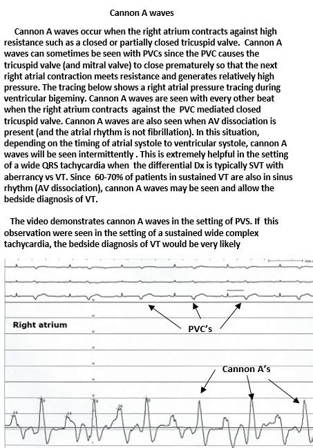 Venous Cannon A Wave