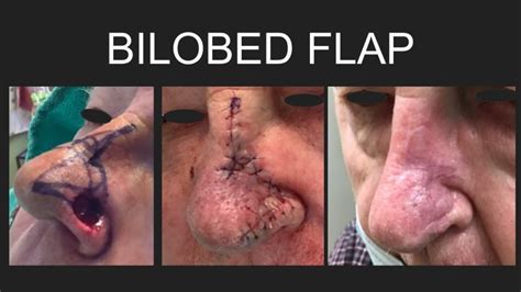 The BILOBED FLAP