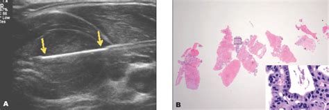 Comparison Of The Efficacy And Safety Of Ultrasound Guided Core Needle Biopsy Versus Fine Needle