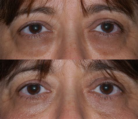 Lower Lid Blepharoplasty Before and After | Center for Excellence in Eye Care