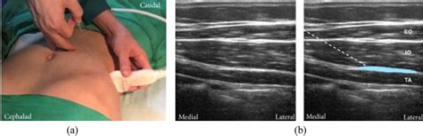 Lateral Approach For Transversus Abdominis Plane TAP Block A The