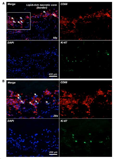 Coexpression Of Proliferative Marker Ki 67 In Human Carotid Plaque