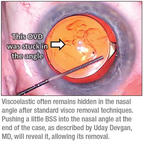 Cataract Surgery In Advanced Glaucoma