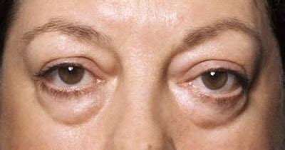 Anti Aging Treatments: Eye Bags, Causes and Tips to Aviod It