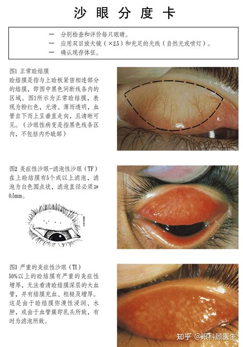 什么是沙眼？ 知乎