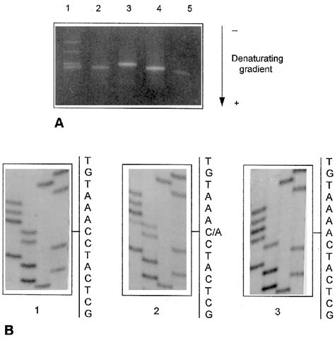 A BmCharacterization Of The 373C A Polymorphism In Exon 2 By DGGE