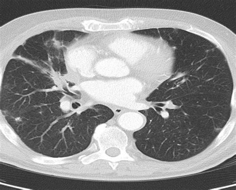 Explorations Thorax Scanner Fibroscopie Endoscopie H P Bichat Chirvtt