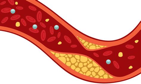 Cholesterol Importance Types Causesrisk Factors And To Reduce