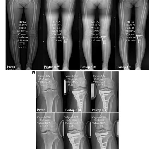 A Standing Whole Leg And B Varus Valgus Stress Radiographs From Download Scientific Diagram