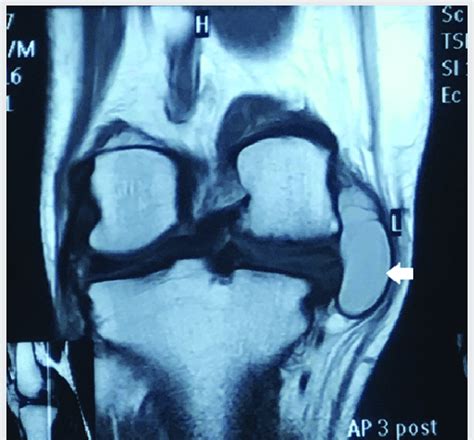 B T1 Weighted Coronal Image Showing A Hypointense Large Medial