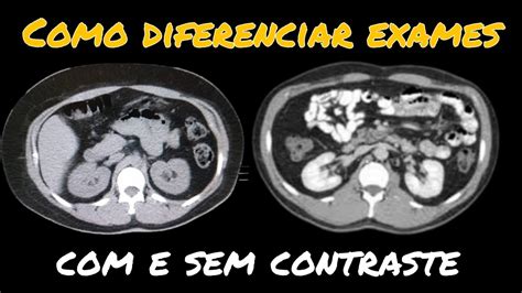 Como Diferenciar Exames Sem Contraste E Contraste Na Tomografia