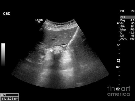 Gallstone Ultrasound Scan 3 By Science Photo Library