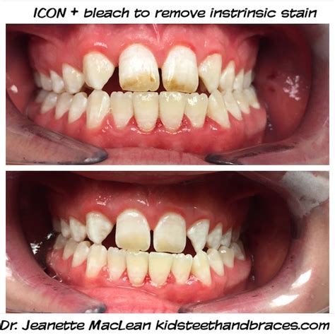 ICON Resin Infiltration | Affiliated Children's Dental Specialists