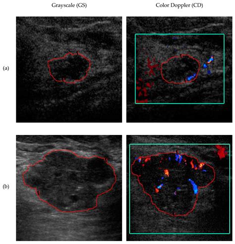 What Do The Colors Mean On Doppler Ultrasound - Infoupdate.org