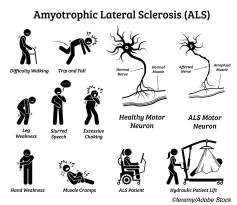 New Als Genetic Risk Factor Identified Physician S Weekly