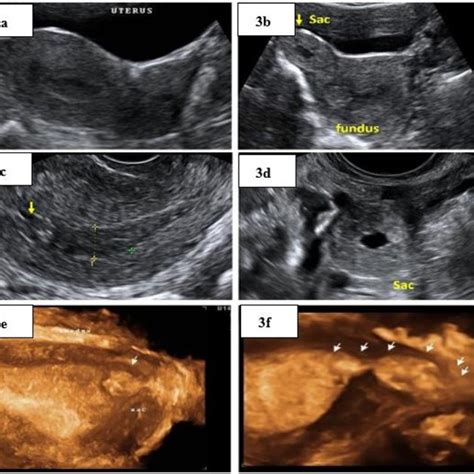 The Embryo E Is Visible Using 2d A And 3d B Transvaginal