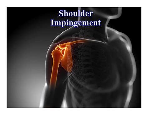 Shoulder Injury From Car Accident 2022 Research