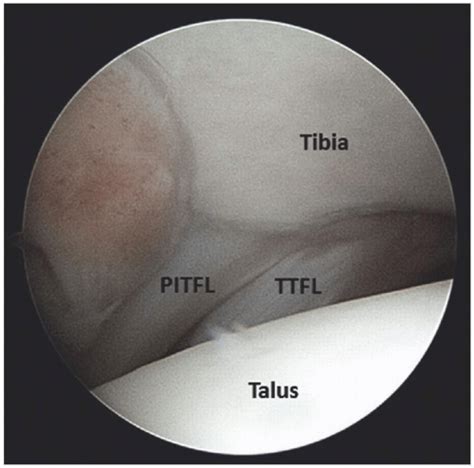 Principles of Ankle Arthroscopy | Musculoskeletal Key