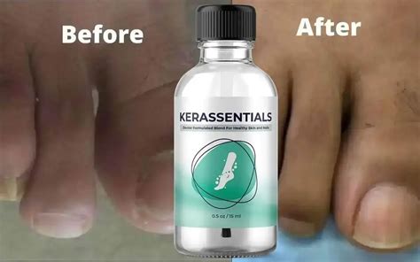 Kerassentials Official Website Toenail Fungus Kerassential Oil