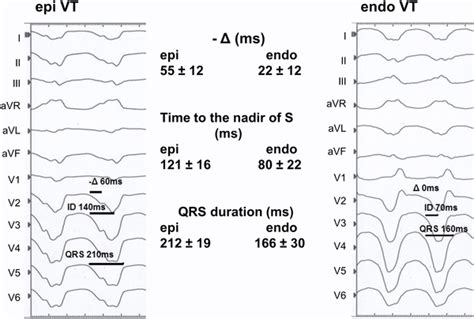 12 Lead ECG During Epicardial VT Epi VT And Endocardial VT Endo VT