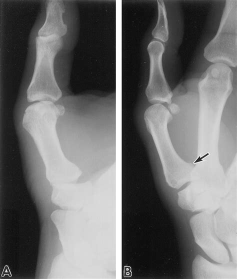 Radiographs At Years After Injury Show That The First Carpometacarpal