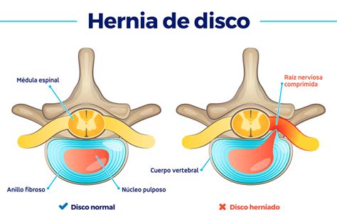 Hernia de disco causas síntomas diagnóstico y tratamiento