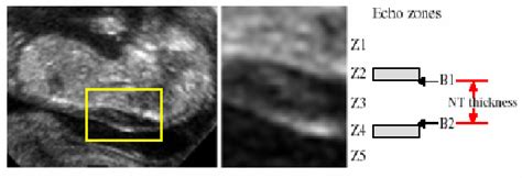 Figure 2 From Measurement Of Nuchal Translucency Thickness For