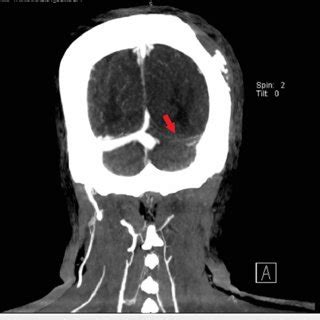 CT head venogram: arrow showing new filling defect in the left sigmoid ...