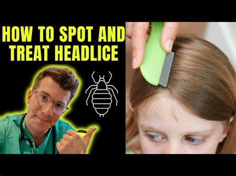 How To Check For Lice On Yourself A Comprehensive Guide Siresays