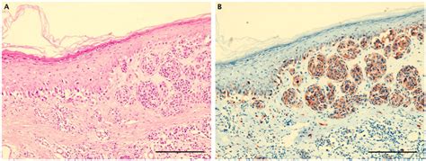 Representative Staining In A Case Of Superficial Spreading Melanoma