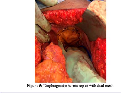 Figure From Congenital Diaphragmatic Hernia With Extra Lobar