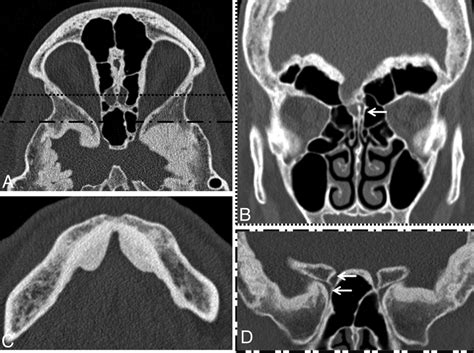 Sphenoid Ethmoid Mandible A Axial Image Of 23 Year Old Woman