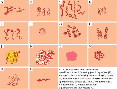 Figure 5 from Vascular structures in dermoscopy* | Semantic Scholar