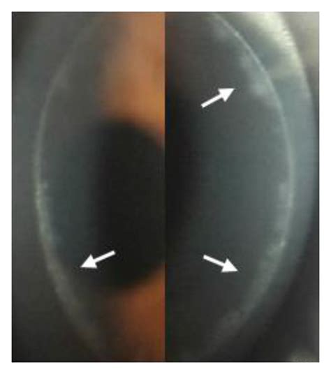 Corneal Flap Margin And Adjacent Regions Photographed By Slit Lamp