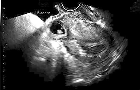 Scielo Brasil Local Management With Methotrexate Of Cesarean Scar