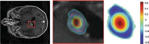 5 Left An Axial Slice Of Contrast Enhanced T1 Mri Of A Patient With A