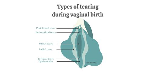 Types Of Childbirth Delivery at Carolyn Bey blog